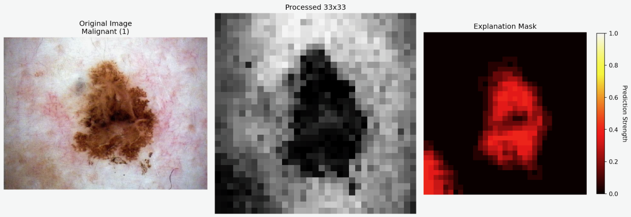 Melanoma Image Analysis Example